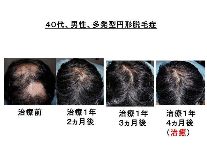 汎発性脱毛　病院